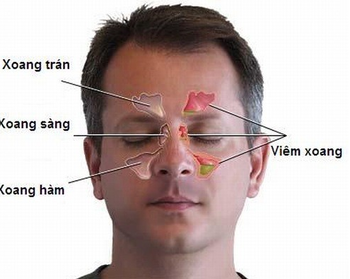 Nghẹt mũi, đau đầu vùng trán mũi là biểu hiện của bệnh gì?
