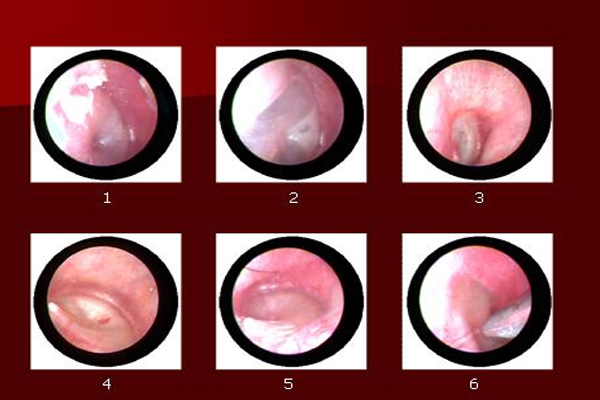 Viêm Tai Giữa Cấp