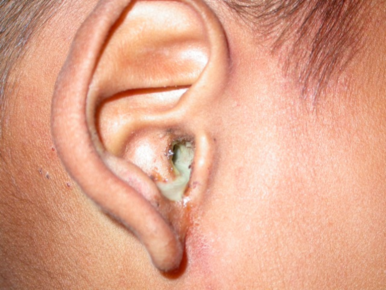 Hướng dẫn cách điều trị nấm tai kèm ù tai hiệu quả nhanh chóng